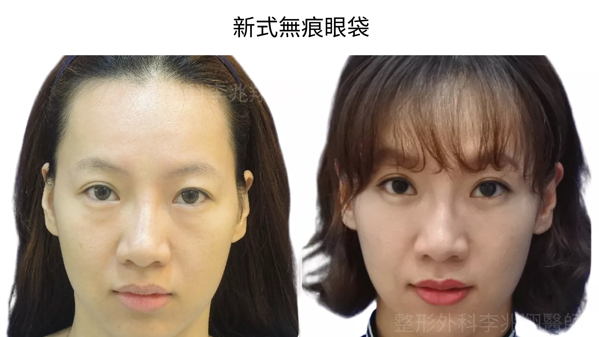 新式無痕眼袋