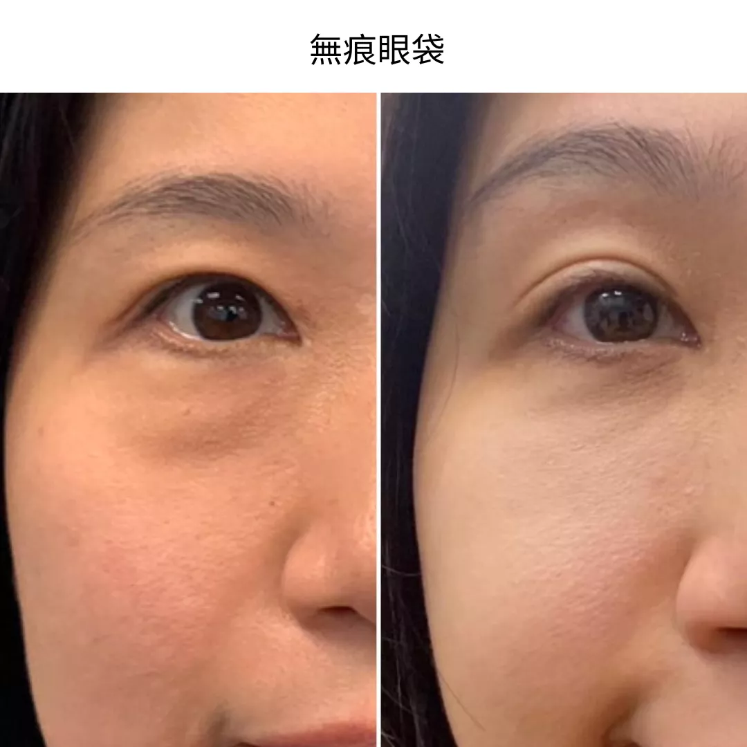 新式無痕眼袋