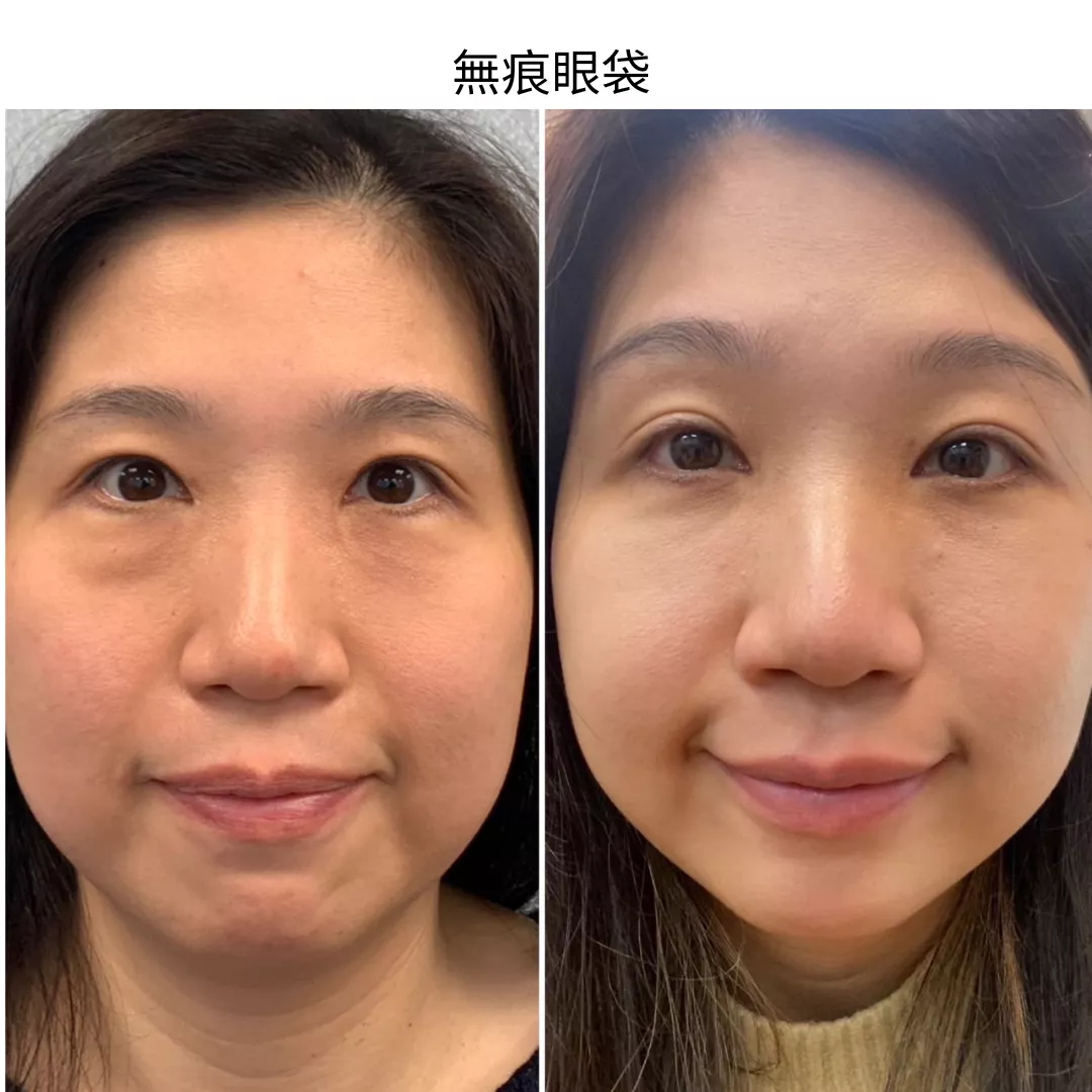 新式無痕眼袋