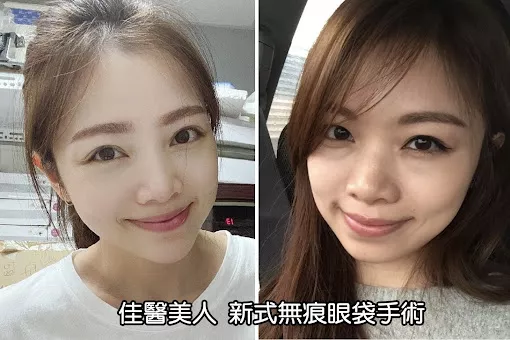 新式無痕眼袋
