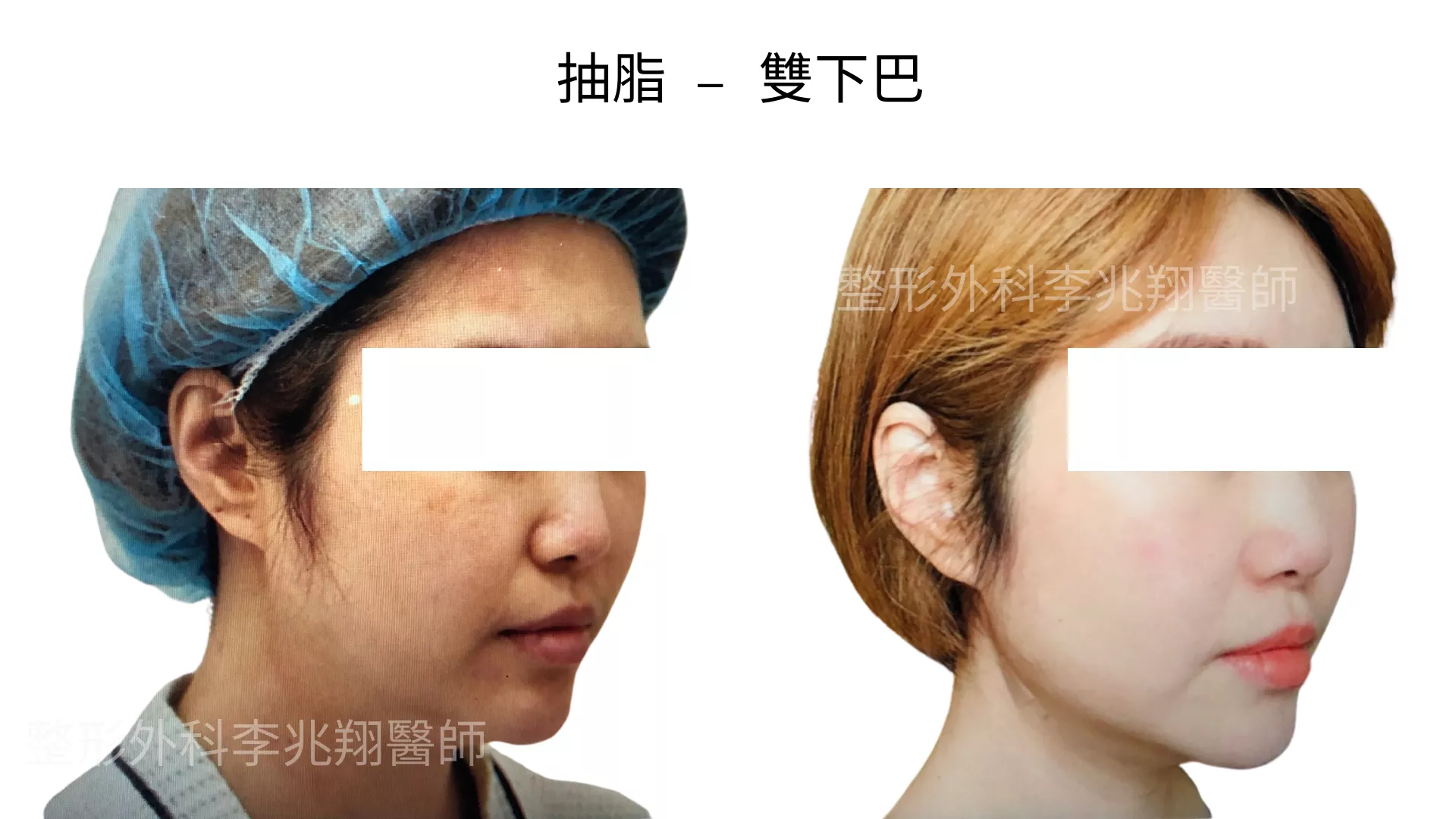 雙下巴抽脂