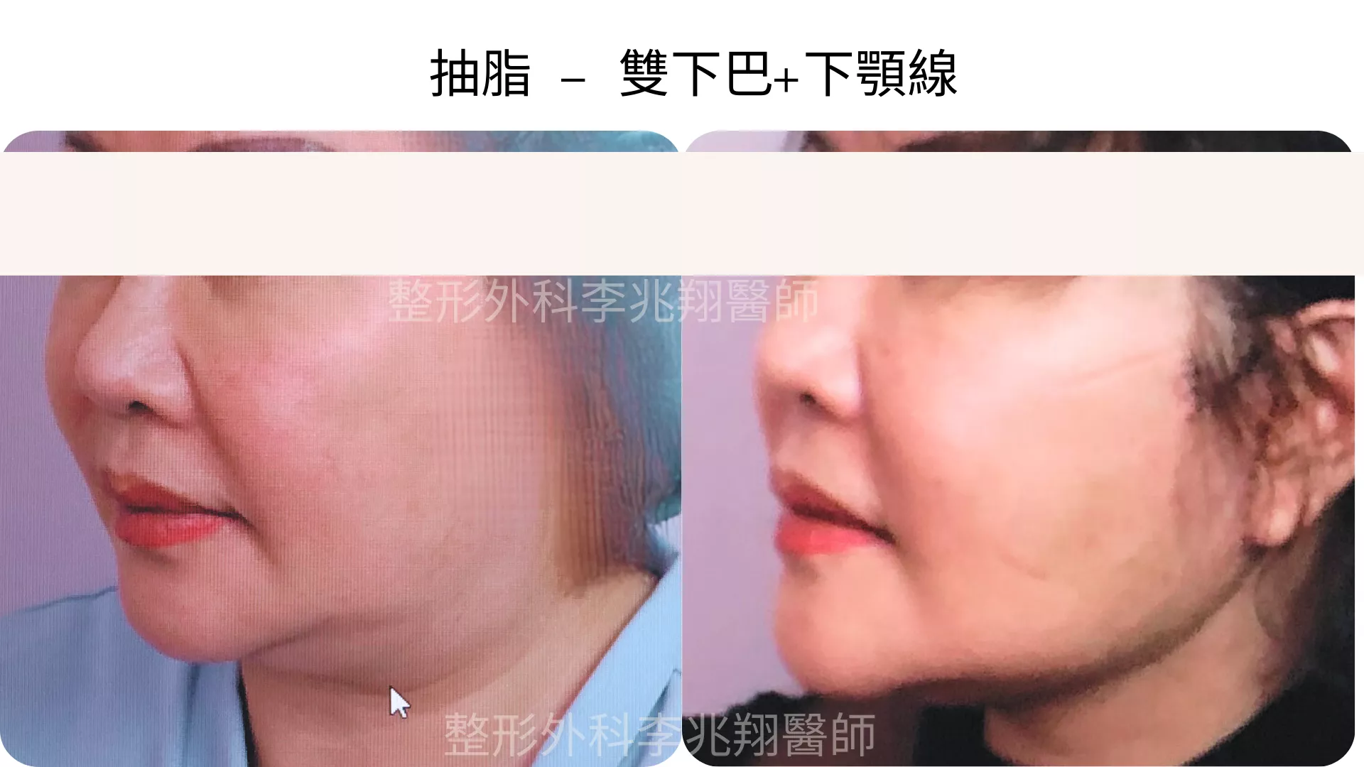 雙下巴抽脂