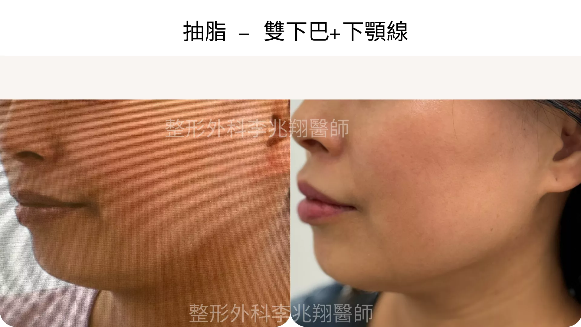 雙下巴抽脂