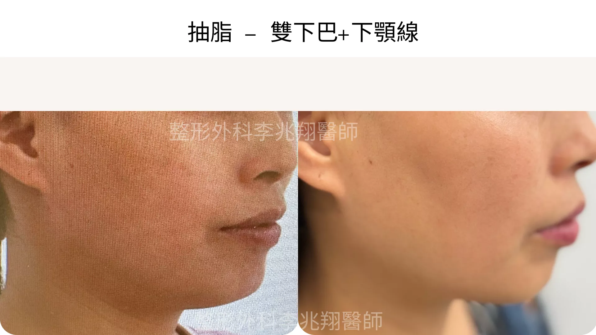 雙下巴抽脂