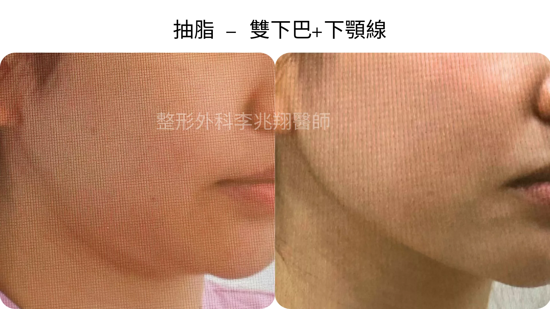 雙下巴抽脂