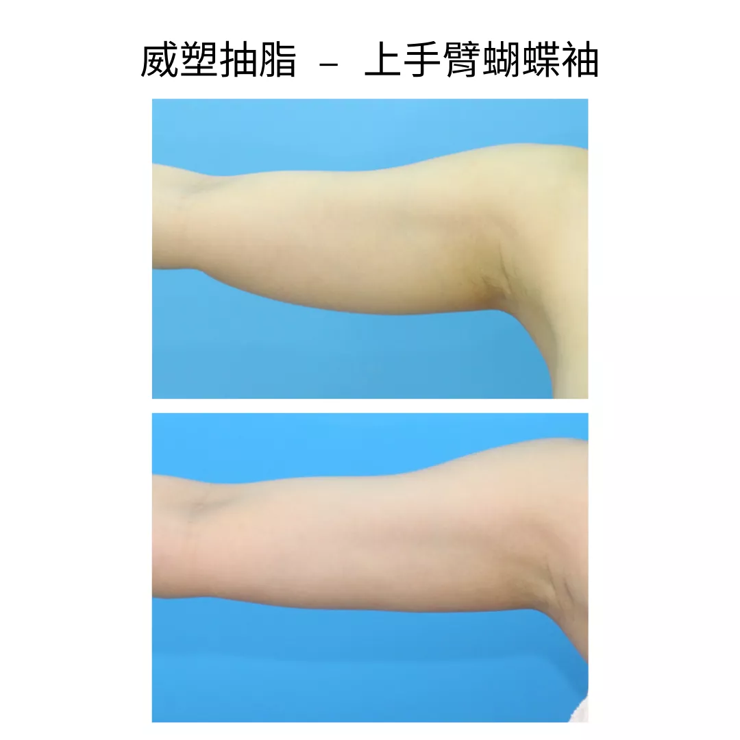 手臂抽脂