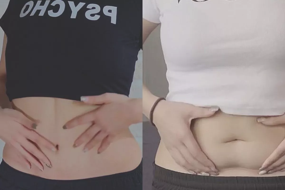 威塑二代抽脂&超能電漿 | 重現緊緻身材